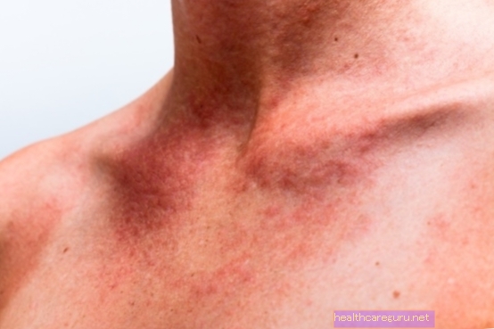 Alergie na opalovací krém: příznaky a co dělat