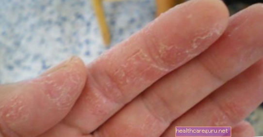 手のアレルギー：原因、症状、治療