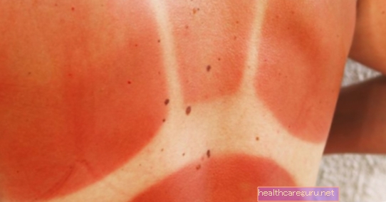 4 съвета за естествено лечение на слънчевите изгаряния