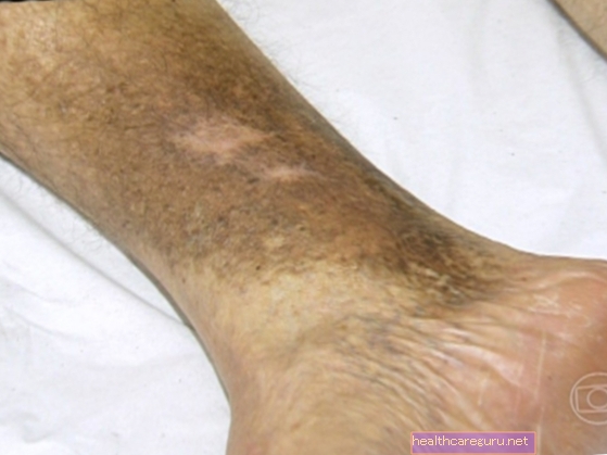 Does varicose veins cure?
