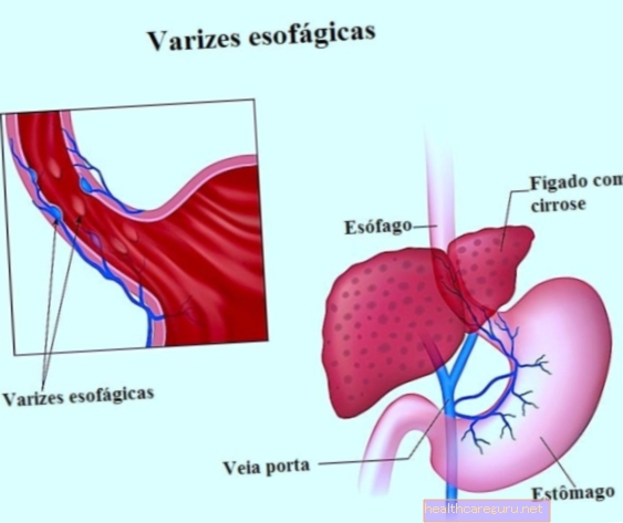 Penyebab varises, gejala dan rawatan esofagus