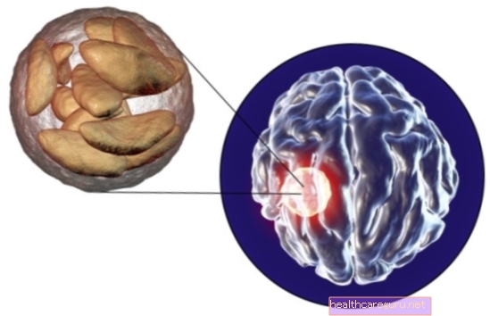 Hva er hjerneabscess og hvordan man identifiserer