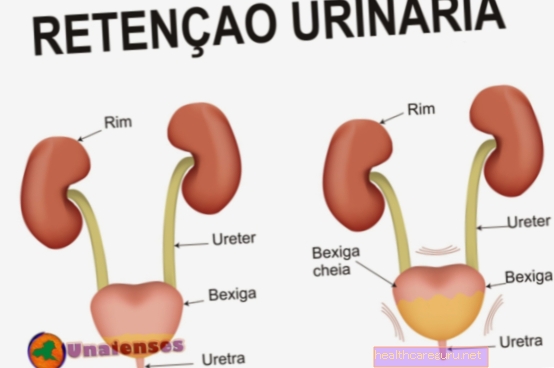 Hva er urinretensjon og hvordan gjøres behandlingen