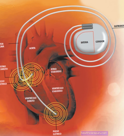 Для чого призначений кардіостимулятор і як він працює