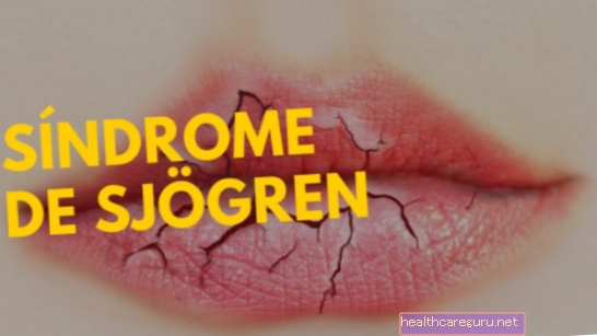 Tratamentul sindromului Sjogren
