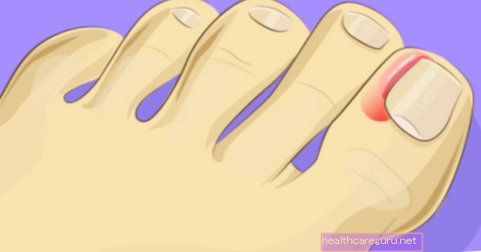 Bolni nokti: Kako se brinuti i lijekovi