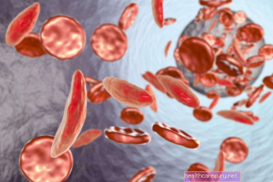 Fanconijeva anemija: kaj je to, glavni simptomi in zdravljenje