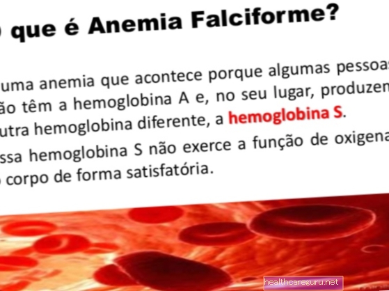 Srpastocelična anemija: kaj je to, simptomi, vzroki in zdravljenje