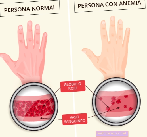 Cara menyembuhkan anemia megaloblastik