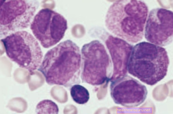 سرطان الدم النخاعي الحاد (AML): ما هو ، الأعراض والعلاج
