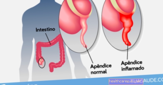 Appendicite: qu'est-ce que c'est, symptômes et traitement