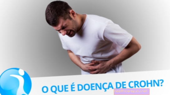 Crohns sygdom: hvad det er, symptomer, årsager og behandling