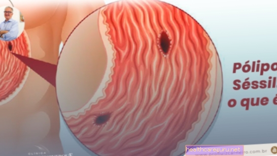 Sittbar polyp: vad är det, när kan det vara cancer och behandling