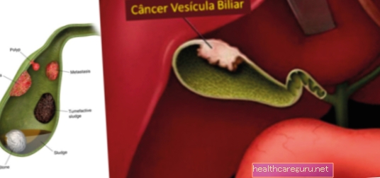Traitement du cancer de la vésicule biliaire