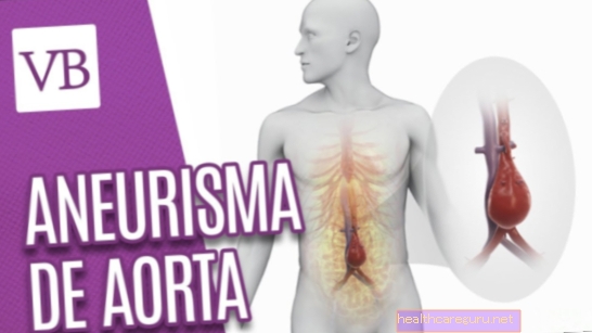 Aneuryzma aorty: čo to je, príznaky, liečba a chirurgický zákrok