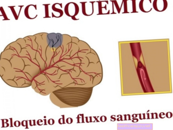 Ishemična možganska kap: kaj je, vzroki, simptomi in zdravljenje