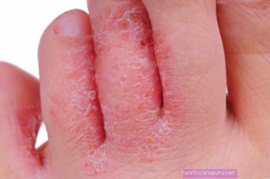 7 odos grybelio tipai ir kaip gydyti