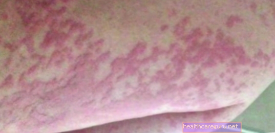 Alergia na pot / ciepło: co to jest, objawy i leczenie