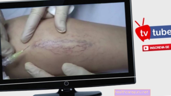 Bagaimana rawatan dermatitis stasis