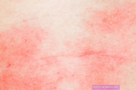 Allergiline dermatiit