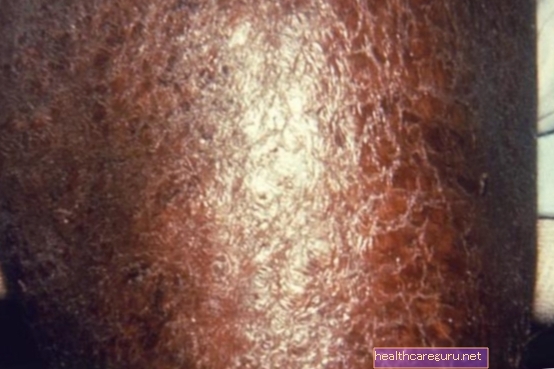 التهاب الجلد التقشري: ما هو وأعراضه وكيفية علاجه
