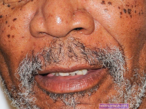 التهاب الجلد الحطاطي الأسود هو مرض جلدي يتميز بظهور حطاطات مصطبغة ، بنية أو سوداء اللون. تعرف على الأسباب وكيفية العلاج