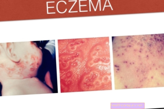 الإكزيما: ماهيتها وأعراضها وأسبابها وعلاجها