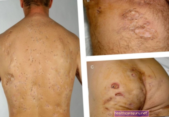 Hidradenitis suppurativa (omvendt acne): de vigtigste symptomer og hvordan man behandler dem