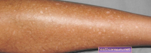 Leucoderma gutata (taches de rousseur blanches): qu'est-ce que c'est et comment traiter