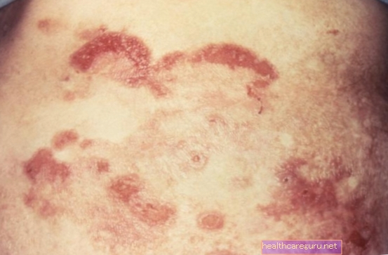 Fungoidní kožní onemocnění: co to je, příznaky a jak se léčba provádí
