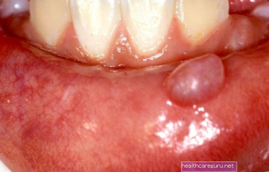 Мукоцеле (пухир у роті): що це таке, як визначити та лікувати