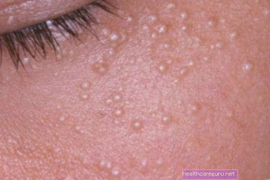 Qu'est-ce que le milium sur la peau, les symptômes et comment l'enlever