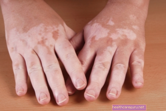 Was kann Vitiligo verursachen und wie zu behandeln