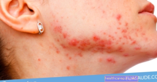 Pengobatan utama untuk mengatasi jerawat (acne)