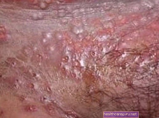 Príznaky a prostriedky na liečbu genitálneho herpesu používané pri liečbe