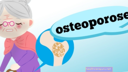 Čo je osteoporóza, príčiny, príznaky a liečba