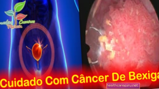 Symptômes du cancer de la vessie, principales causes et comment traiter