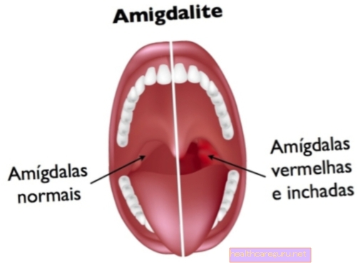 Tonsillitis: hvad det er, når det er viralt eller bakterielt og behandles