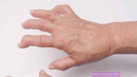 Käte artroos: sümptomid, põhjused ja ravi