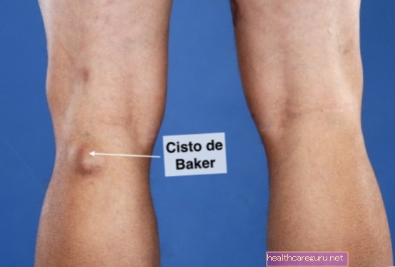 Benjolan di belakang lutut mungkin Bakter Cyst