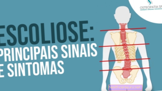 Scoliosis คืออะไรอาการประเภทและการรักษา
