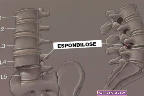 Lumbar spondyloarthrosis: hvad det er, symptomer og behandling