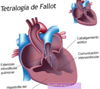 Tetralogy of Fallot: what it is, symptoms and treatment