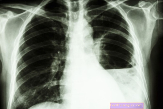 What is lung abscess, symptoms, causes and how to treat