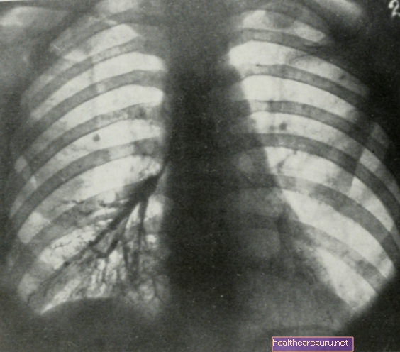 Bệnh bụi phổi: bệnh gì, cách phòng ngừa và điều trị
