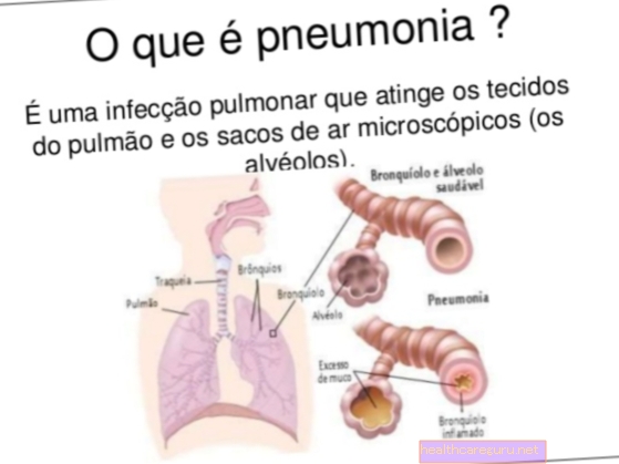 Virusinė pneumonija: kas tai yra, pagrindiniai simptomai ir gydymas