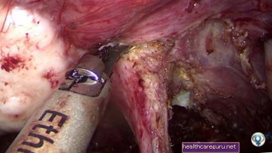 Chirurgie de l'endométriose: quand elle est indiquée et récupération