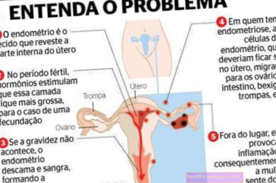 Endometrios i äggstocken: vad det är, symtom och behandling