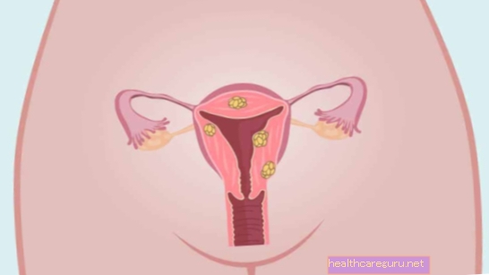 Menstruation med blodproppar: 7 huvudorsaker och vad man ska göra