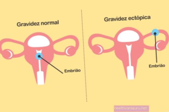 Hovedårsakene til graviditet i rørene (ektopisk) og hvordan de skal behandles